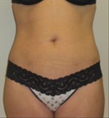 Tummy Tuck After Photo by Carmen Kavali, MD; Atlanta, GA - Case 25382