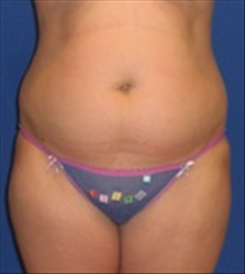 Tummy Tuck Before Photo by Carmen Kavali, MD; Atlanta, GA - Case 25382