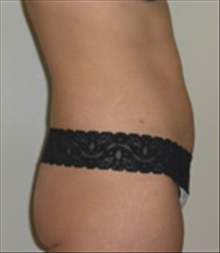 Tummy Tuck After Photo by Carmen Kavali, MD; Atlanta, GA - Case 25382