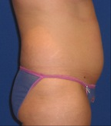 Tummy Tuck Before Photo by Carmen Kavali, MD; Atlanta, GA - Case 25382