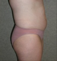 Tummy Tuck Before Photo by Carmen Kavali, MD; Atlanta, GA - Case 25383