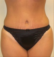 Tummy Tuck After Photo by Carmen Kavali, MD; Atlanta, GA - Case 25384