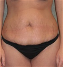 Tummy Tuck Before Photo by Carmen Kavali, MD; Atlanta, GA - Case 25384