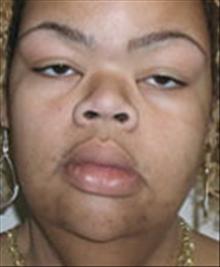 Facelift Before Photo by Carmen Kavali, MD; Atlanta, GA - Case 25388