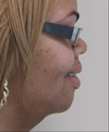 Facelift After Photo by Carmen Kavali, MD; Atlanta, GA - Case 25388