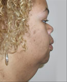 Facelift Before Photo by Carmen Kavali, MD; Atlanta, GA - Case 25388