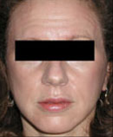 Facelift After Photo by Carmen Kavali, MD; Atlanta, GA - Case 25389