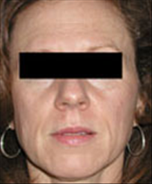 Facelift Before Photo by Carmen Kavali, MD; Atlanta, GA - Case 25389