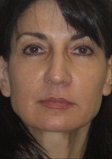 Dermal Fillers After Photo by Carmen Kavali, MD; Atlanta, GA - Case 25392