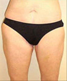 Body Contouring After Photo by Carmen Kavali, MD; Atlanta, GA - Case 25393