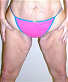 Body Contouring Before Photo by Carmen Kavali, MD; Atlanta, GA - Case 25393