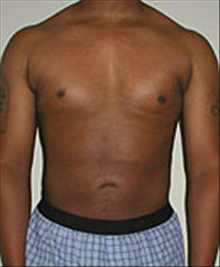 Liposuction After Photo by Carmen Kavali, MD; Atlanta, GA - Case 25395