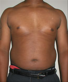 Liposuction Before Photo by Carmen Kavali, MD; Atlanta, GA - Case 25395