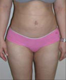 Liposuction After Photo by Carmen Kavali, MD; Atlanta, GA - Case 25396
