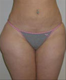 Liposuction Before Photo by Carmen Kavali, MD; Atlanta, GA - Case 25396