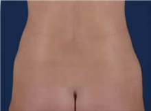 Liposuction After Photo by Carmen Kavali, MD; Atlanta, GA - Case 25399