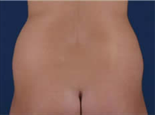 Liposuction Before Photo by Carmen Kavali, MD; Atlanta, GA - Case 25399