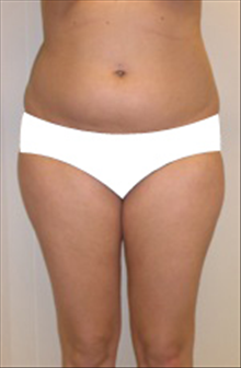 Liposuction Before Photo by Carmen Kavali, MD; Atlanta, GA - Case 25402