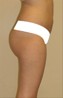 Liposuction After Photo by Carmen Kavali, MD; Atlanta, GA - Case 25402