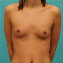 Breast Augmentation Before Photo by Michael Bogdan, MD, MBA, FACS; Grapevine, TX - Case 21182