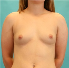 Breast Augmentation Before Photo by Michael Bogdan, MD, MBA, FACS; Grapevine, TX - Case 21183
