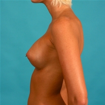 Breast Augmentation After Photo by Michael Bogdan, MD, MBA, FACS; Grapevine, TX - Case 21184