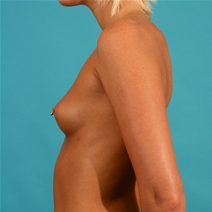 Breast Augmentation Before Photo by Michael Bogdan, MD, MBA, FACS; Grapevine, TX - Case 21184
