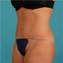 Tummy Tuck After Photo by Michael Bogdan, MD, MBA, FACS; Grapevine, TX - Case 21237