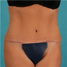 Tummy Tuck After Photo by Michael Bogdan, MD, MBA, FACS; Grapevine, TX - Case 21237