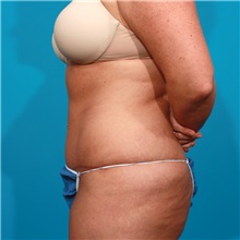 Tummy Tuck After Photo by Michael Bogdan, MD, MBA, FACS; Grapevine, TX - Case 21238