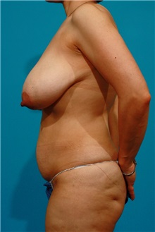Tummy Tuck Before Photo by Michael Bogdan, MD, MBA, FACS; Grapevine, TX - Case 21243