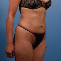 Liposuction After Photo by Michael Bogdan, MD, MBA, FACS; Grapevine, TX - Case 22878
