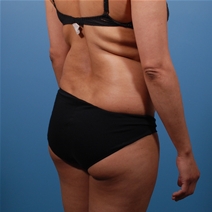Liposuction Before Photo by Michael Bogdan, MD, MBA, FACS; Grapevine, TX - Case 22878