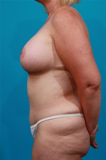 Tummy Tuck After Photo by Michael Bogdan, MD, MBA, FACS; Grapevine, TX - Case 22879