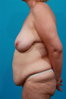 Tummy Tuck Before Photo by Michael Bogdan, MD, MBA, FACS; Grapevine, TX - Case 22879