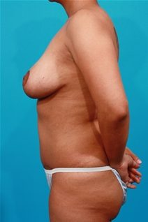 Tummy Tuck After Photo by Michael Bogdan, MD, MBA, FACS; Grapevine, TX - Case 22880