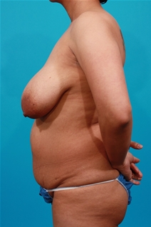 Tummy Tuck Before Photo by Michael Bogdan, MD, MBA, FACS; Grapevine, TX - Case 22880