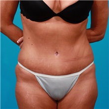 Tummy Tuck After Photo by Michael Bogdan, MD, MBA, FACS; Grapevine, TX - Case 22882