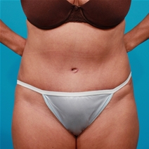 Tummy Tuck After Photo by Michael Bogdan, MD, MBA, FACS; Grapevine, TX - Case 22883