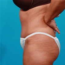 Tummy Tuck After Photo by Michael Bogdan, MD, MBA, FACS; Grapevine, TX - Case 22883