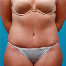 Tummy Tuck After Photo by Michael Bogdan, MD, MBA, FACS; Grapevine, TX - Case 22884