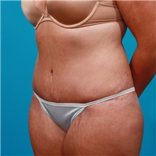 Tummy Tuck After Photo by Michael Bogdan, MD, MBA, FACS; Grapevine, TX - Case 22884
