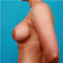 Breast Augmentation After Photo by Michael Bogdan, MD, MBA, FACS; Grapevine, TX - Case 22887