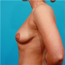 Breast Augmentation Before Photo by Michael Bogdan, MD, MBA, FACS; Grapevine, TX - Case 22887