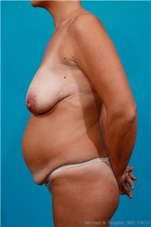 Tummy Tuck Before Photo by Michael Bogdan, MD, MBA, FACS; Grapevine, TX - Case 23988
