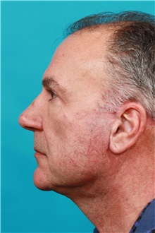 Facelift After Photo by Michael Bogdan, MD, MBA, FACS; Grapevine, TX - Case 31847