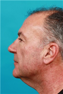 Facelift Before Photo by Michael Bogdan, MD, MBA, FACS; Grapevine, TX - Case 31847