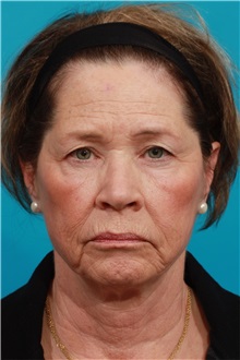 Facelift Before Photo by Michael Bogdan, MD, MBA, FACS; Grapevine, TX - Case 31848