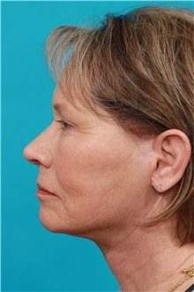 Facelift After Photo by Michael Bogdan, MD, MBA, FACS; Grapevine, TX - Case 31848