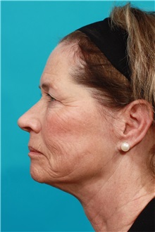 Facelift Before Photo by Michael Bogdan, MD, MBA, FACS; Grapevine, TX - Case 31848